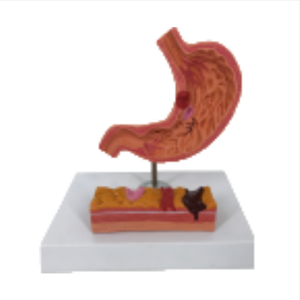 Modèle de Pathologie Gastrique D021F/D021G pour l'enseignement et l'apprentissage de l'Anatomie en Sciences Médicales pour la Formation des Infirmières - Product Image 2
