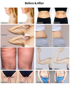 Máquina Onda Pro Coolwave Portátil Multifuncional para Lifting Facial, Moldeado Corporal ABS, Quema de Grasa y Eliminación de Celulitis - Product Image 5