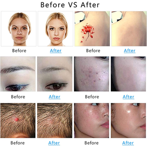 PAKISS portátil no invasivo ABS Acero inoxidable ceja tatuaje eliminación de pecas picosegundo modelo de instrumento de belleza comercial - Product Image 2