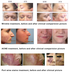 KN-7000D máy y tế 7 màu sắc đèn chromotherapy trẻ hóa da ánh sáng mặt <span class=keywords><strong>PDT</strong></span> <span class=keywords><strong>LED</strong></span> liệu pháp ánh sáng máy đẹp - Product Image 5