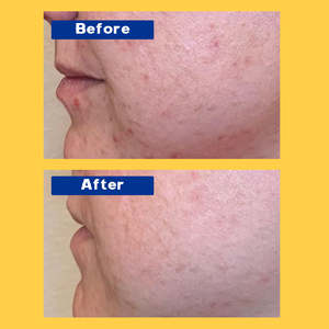 Bosman OEM Esencia antiacné de ácido salicílico Desbloquea profundamente los poros Reduce el enrojecimiento facial Hinchazón Calma la piel Esencia facial - Product Image 6