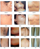 Appareil d'épilation au laser diode 808 nm pour SDL-B, homologué CE, épilation permanente pour salon de beauté, refroidissement par glace