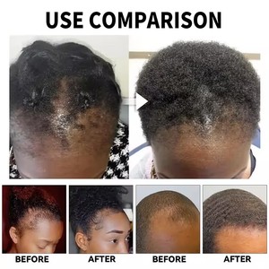 Sérum Bio Anti-Chute de Cheveux au Gingembre Extra Fort, Sans Rinçage, Huile Revitalisante <span class=keywords><strong>pour</strong></span> la Croissance Capillaire – Meilleures Ventes, Prix Abordable, Idéal <span class=keywords><strong>pour</strong></span> le Dropshipping - Product Image 4