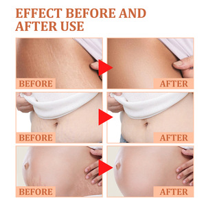 Wholesale <b>Pregnancy</b> Scar Repair <b>Cream</b> Enhances Skin Elasticity Moisturizes and Tightens Skin Improves Skin Roughness Dullness - Product Image 6