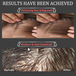 Shampoo de croissance des cheveux professionnel pour hommes et femmes en marque privée, traitement <span class=keywords><strong>anti</strong></span>-chute de cheveux, shampooing pour la croissance de la <span class=keywords><strong>calvitie</strong></span> - Product Image 4