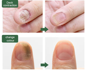 Traitement Liquide Extra Fort Contre la <span class=keywords><strong>Mycose</strong></span> des Ongles 25% Acide Undécylénique, Soin <span class=keywords><strong>Antifongique</strong></span> pour Ongles des Pieds et des Mains à l'Huile d'Arbre à Thé pour la Peau des Pieds - Product Image 5