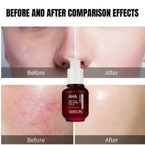 Sérum anti-acné à l'<span class=keywords><strong>acide</strong></span> de fruits et à l'<span class=keywords><strong>acide</strong></span> <span class=keywords><strong>salicylique</strong></span> 30 ml, vente en gros, essence hydratante pour le visage, pour les marques d'acné, contrôle du sébum, soin de la peau - Product Image 4