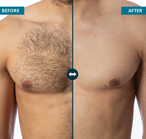 Dispositivo Láser Profesional para Depilación 808nm con Energía y Frecuencia Ajustables para Tratamiento Personalizado, Máquina Láser de Diodo para Salón - Product Image 5