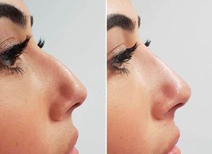 Vente en gros – Acide hyaluronique réticulé BDDE approuvé CE, non chirurgical, pour remodelage nasal et augmentation du <span class=keywords><strong>volume</strong></span> du nez - Product Image 6