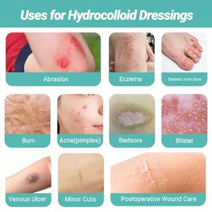 YOJO Parche de Vendaje en Rollo Hidrocoloide Autoadhesivo, Impermeable, Flexible, Ultra Absorbente, Esterilizado con EO, Tamaño Extra Grande - Product Image 5