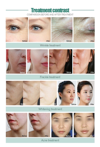 Dispositivo de Cuidado de la Piel Jet Peel de Grado Comercial con Flujo de Gotas Moleculares de 5-20um, Estimulación de Colágeno, Reducción de Arrugas e Hidratación - Product Image 4