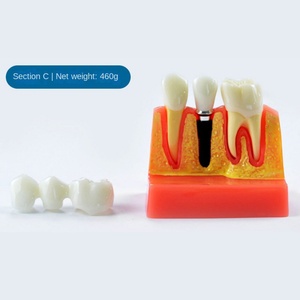 Modelo Dental de Plástico Resistente, Ampliado 4 Veces, Modelo de Enseñanza para Médico-Paciente, Accesorios Multiusos para Blanqueamiento Dental - Product Image 1