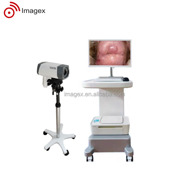 OEM/ODM Digital HD Video Colposcope Microscope of the Vagina and Vulva with LED Cold Light for Gynecology