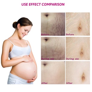 OEM-Crema de eliminación de marcas de estiramiento, sello personalizado de 100ml, mango orgánico natural, crema para el vientre y el embarazo - Product Image 4