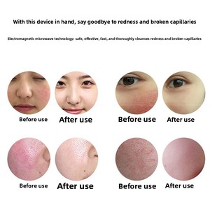 Instrumento de Bloqueo para Eliminación de Manchas Rojas en la Piel, Modelo SL-ZDY de Aleación de Cromo, Resistente al Agua, para Uso en Salones de Belleza - Product Image 4