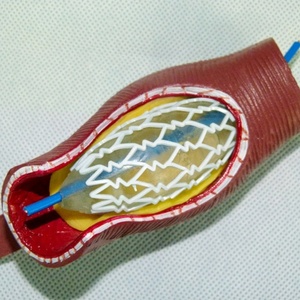 Modelo Anatómico de <span class=keywords><strong>Stent</strong></span> Vascular Humano SMM3192 (PVC) para Educación en Ciencias Médicas - Arteria Coronaria - Product Image 5