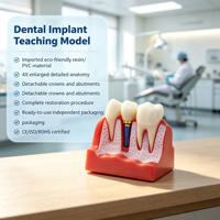 Modèle d'implant dentaire agrandi 4 fois, couronne et pont amovibles pour l'éducation des dentistes et des patients, certifié CE ISO ROHS CNAS