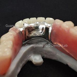 Dentaduras removibles <span class=keywords><strong>de</strong></span> alta calidad con marco <span class=keywords><strong>de</strong></span> metal y dientes acrílicos para prótesis dentales duraderas <span class=keywords><strong>Precio</strong></span> asequible - Product Image 4