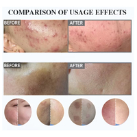 Éponge exfoliante naturelle aux algues et herbes pour la resurfaçage de la peau, élimination des taches d'acné, de pigmentation, des taches brunes et des vergetures