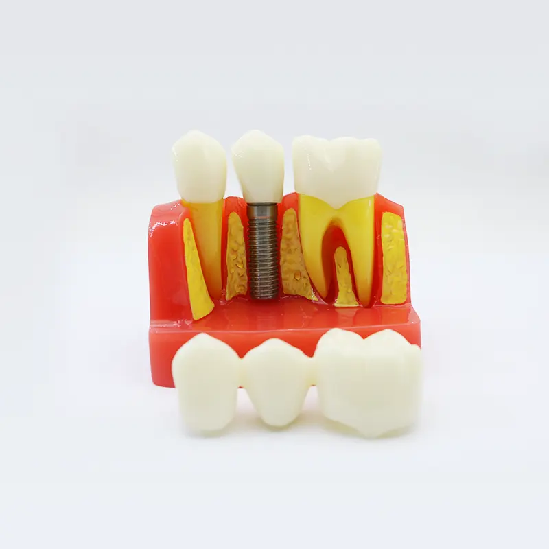 Dental Implant Model Teeth Analysis Crown Bridge Demonstration Tooth Model for Patients Communication and Education