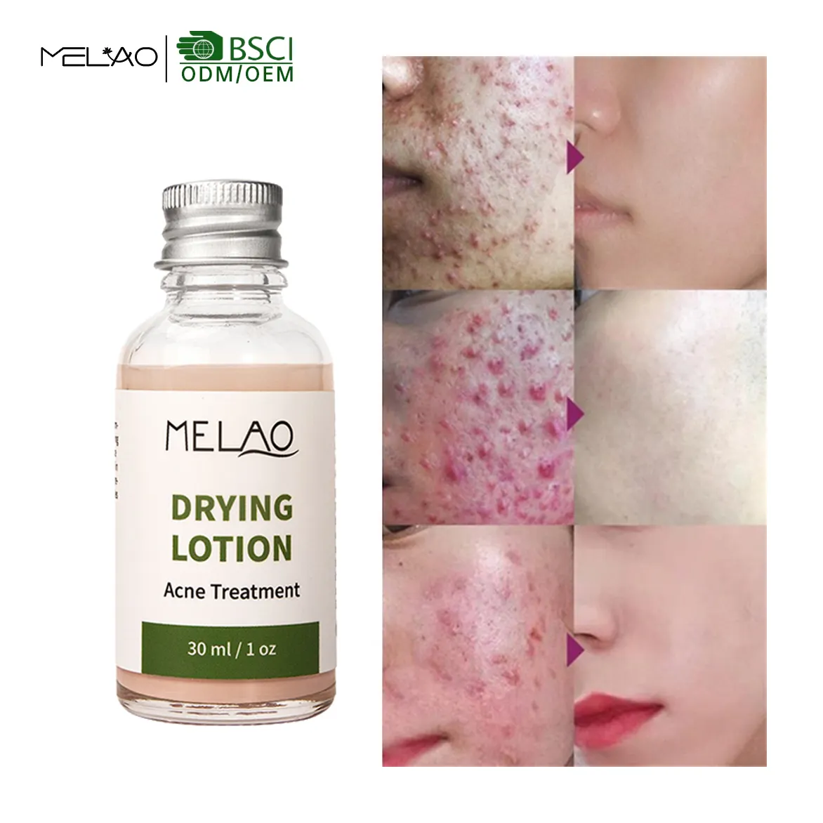 2023 ultima soluzione per la rimozione dell'acne efficiente del viso con acido salicilico per il trattamento dell'acne OEM per la cura della pelle