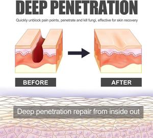 Crema per la Guarigione delle Piaghe <span class=keywords><strong>da</strong></span> <span class=keywords><strong>Decubito</strong></span>, Crema per il <span class=keywords><strong>Trattamento</strong></span> delle Ferite <span class=keywords><strong>da</strong></span> <span class=keywords><strong>Decubito</strong></span>, <span class=keywords><strong>Trattamento</strong></span> per Piaghe <span class=keywords><strong>da</strong></span> <span class=keywords><strong>Decubito</strong></span> sui Glutei - Product Image 4