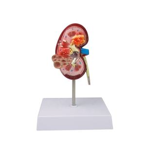 Modelo anatómico de riñón humano, modelo de piedra <span class=keywords><strong>renal</strong></span> de patología <span class=keywords><strong>renal</strong></span> de ciencia médica de PVC para uso escolar - Product Image 1