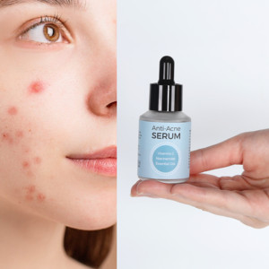 Sérum Traitant Anti-Acné Pur et Original à la <span class=keywords><strong>Niacinamide</strong></span> avec Acides Mandélique et Azélaïque pour les Cicatrices d'Acné (Liquide) - Product Image 1