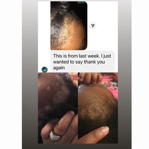Shampoo anti-poux et anti-démangeaisons pour cheveux, marque privée, tue les poux et les œufs, traitement pour enfants et bébés - Product Image 6