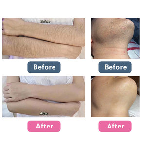 Km mới nhất 2025 Diode <span class=keywords><strong>Laser</strong></span> 3 bước sóng Diode tẩy lông bằng <span class=keywords><strong>laser</strong></span> tẩy lông vĩnh viễn bằng <span class=keywords><strong>laser</strong></span> diodo Ice - Product Image 6