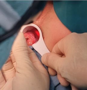 Fistula mesin operasi wasir inframerah, mesin pemotong wasir inframerah 980nm 1470nm Diode <span class=keywords><strong>Laser</strong></span> procologi - Product Image 6