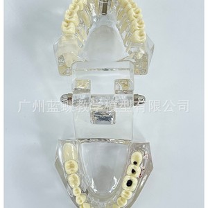 Modelo dental patológico transparente de boca completa para enseñanza médica, patología completa de los dientes, caries, odontología - Product Image 2