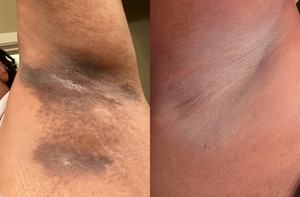 Crème pour les aisselles foncées <span class=keywords><strong>Action</strong></span> rapide en seulement 7 jours Crème éclaircissante pour les aisselles - Product Image 5