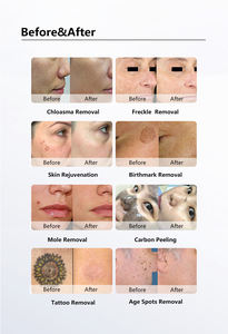 Máquina Láser Multifunción de Picosegundos Nd Yag OPT para Depilación y Rejuvenecimiento de la Piel con 30 Millones de Disparos y Larga Vida Útil - Product Image 6