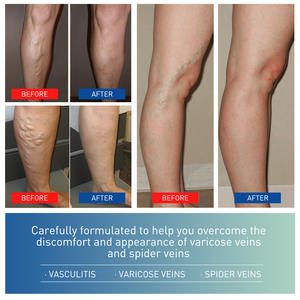 Vente en gros de crème pour les varices crème apaisante pour les jambes crème cicatrisante pour les varices à base de plantes pommade - Product Image 6