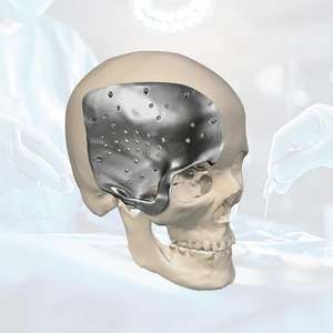 Cadre de reconstruction du visage médial (<span class=keywords><strong>Le</strong></span> Fort) en titane imprimé en 3D sur mesure - Product Image 2