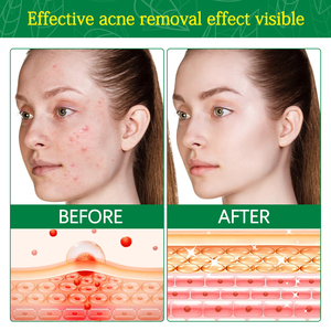 Crema idratante per il siero del tè albero per la cura della <span class=keywords><strong>pelle</strong></span> del viso che riduce le cicatrici da Acne riparazione del siero del viso per il controllo dei pori che restringono la <span class=keywords><strong>pelle</strong></span> chiara - Product Image 6