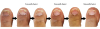 Équipement professionnel portatif de thérapie de laser de diode pour l'élimination de champignon d'ongle sur des soins de beauté sûrs d'orteils et de pieds sur des jambes