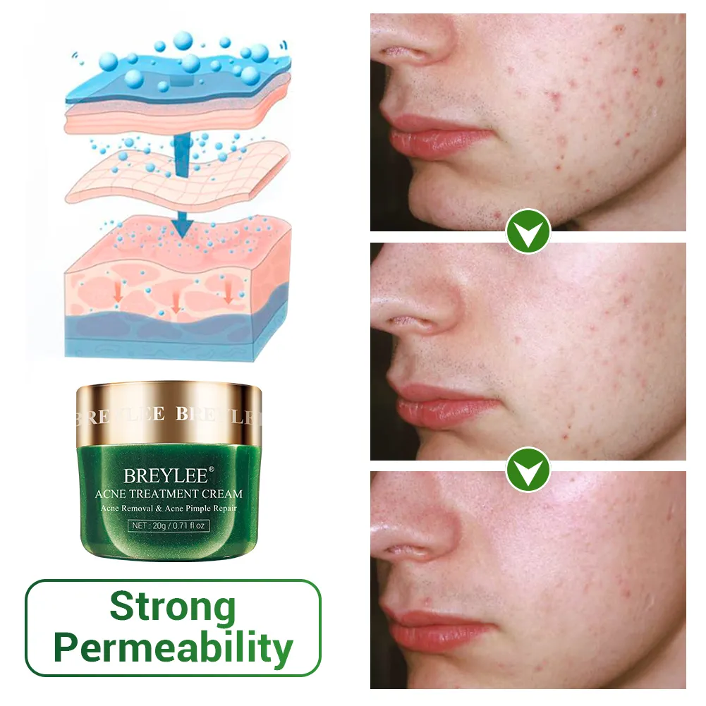 BREYLEE tea tree oil acnes scar care cream removal acne pimples face cream