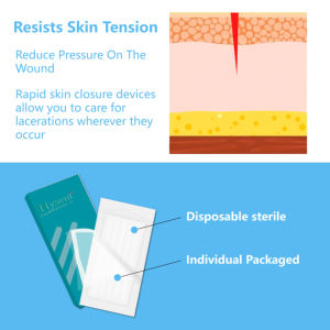 Hysent Wegwerp 3*75Mm EHBO Medische Zelfklevende Wonddressing Steriele Huid Strip Sluiting <span class=keywords><strong>Strips</strong></span> Tape Schoonheid Persoonlijke Verzorging - Product Image 6