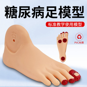 Modelo de cuidado del pie para diabéticos; modelo de lesiones del pie en pacientes diabéticos; cambios patológicos del pie; modelo de pie. - Product Image 2