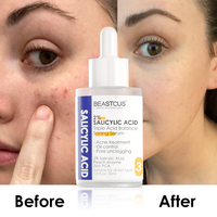 Marque privée Sérum de traitement de l'acné Sérum anti-acné à l'acide salicylique pour le traitement de l'acné