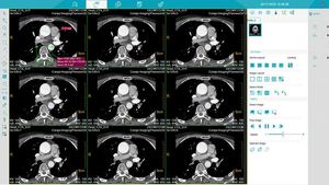 Medsinglong 컴퓨터 단층 촬영 32 슬라이스 스펙트럼 이미징 2D <span class=keywords><strong>3D</strong></span> CT 스캐너 CT 기계 - Product Image 4
