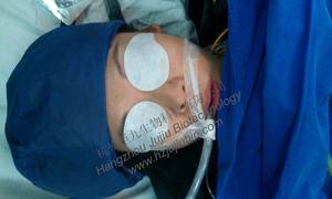 Pelindung Mata Anestesi Hidrogel Sekali Pakai - Product Image 4