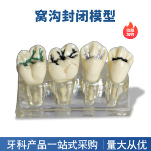 Modelo de Sellador de Fisuras Dentales Transparente para Niños, para la Prevención de Caries, Procedimiento de Obturación Dental, Accesorio de Equipo de Terapia Oral - Product Image 3