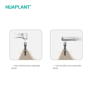 Accessoire manuel d'expansion osseuse Huaplant en acier inoxydable, manipulation d'expansion osseuse, classe I, compatible avec tous les implants de marque - Product Image 4