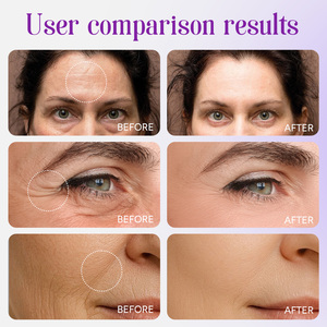 ATOANY Nouveaux Patchs Faciaux <span class=keywords><strong>Anti</strong></span>-Rides Triangulaires pour la Nuit, pour le Front, les Rides d'Expression et les Rides sous les Yeux, pour le Soin de la Peau - Product Image 4