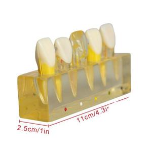 Modelo de Pulpa Dental Anterior con Pulpitis, Modelo de Enseñanza Dental Clínico Patológico, Equipo y Accesorios - Product Image 1