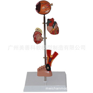 Modelos de patología de la diabetes, modelos de corazón, modelos de riñón, modelos de ojo, modelos de pie diabético, modelos de diabetes - Product Image 1