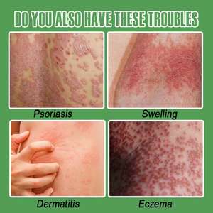 Spray Erboristico Biologico per Eczema, Psoriasi e Dermatite, Lenitivo ad Azione Rapida, Anti-Infiammatorio, Spray per la Cura della Pelle 30ml - Product Image 3